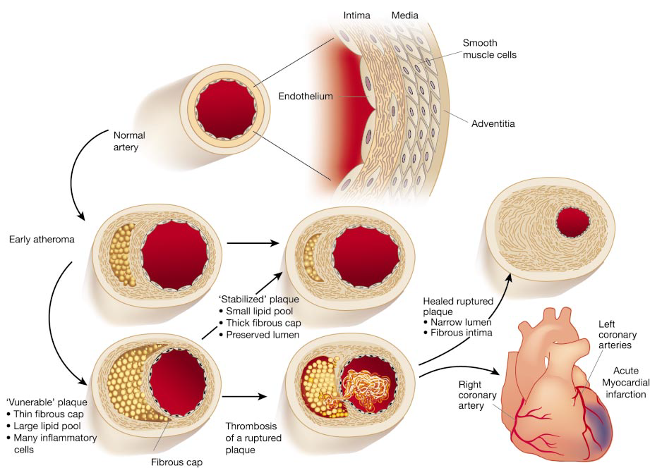 Views of progression from normal artery to acute myocardial infarction and sudden death